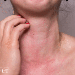 Αλλεργίες του καλοκαιριού: Τι ευθύνεται για τα εξανθήματα και τη φαγούρα